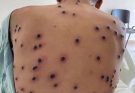 Understanding Monkeypox: Key Guidelines for Managing the Viral Disease #4